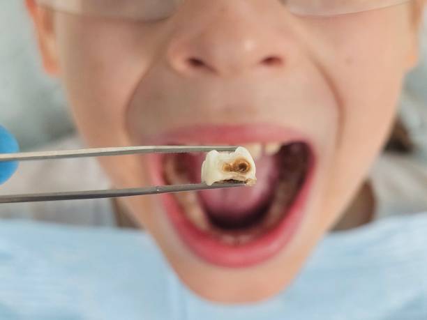 Best Urgent Tooth Repair  in Center Hill, FL
